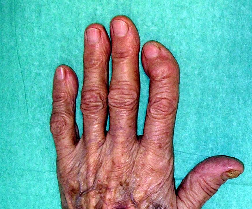 La artrosis de los dedos de la mano