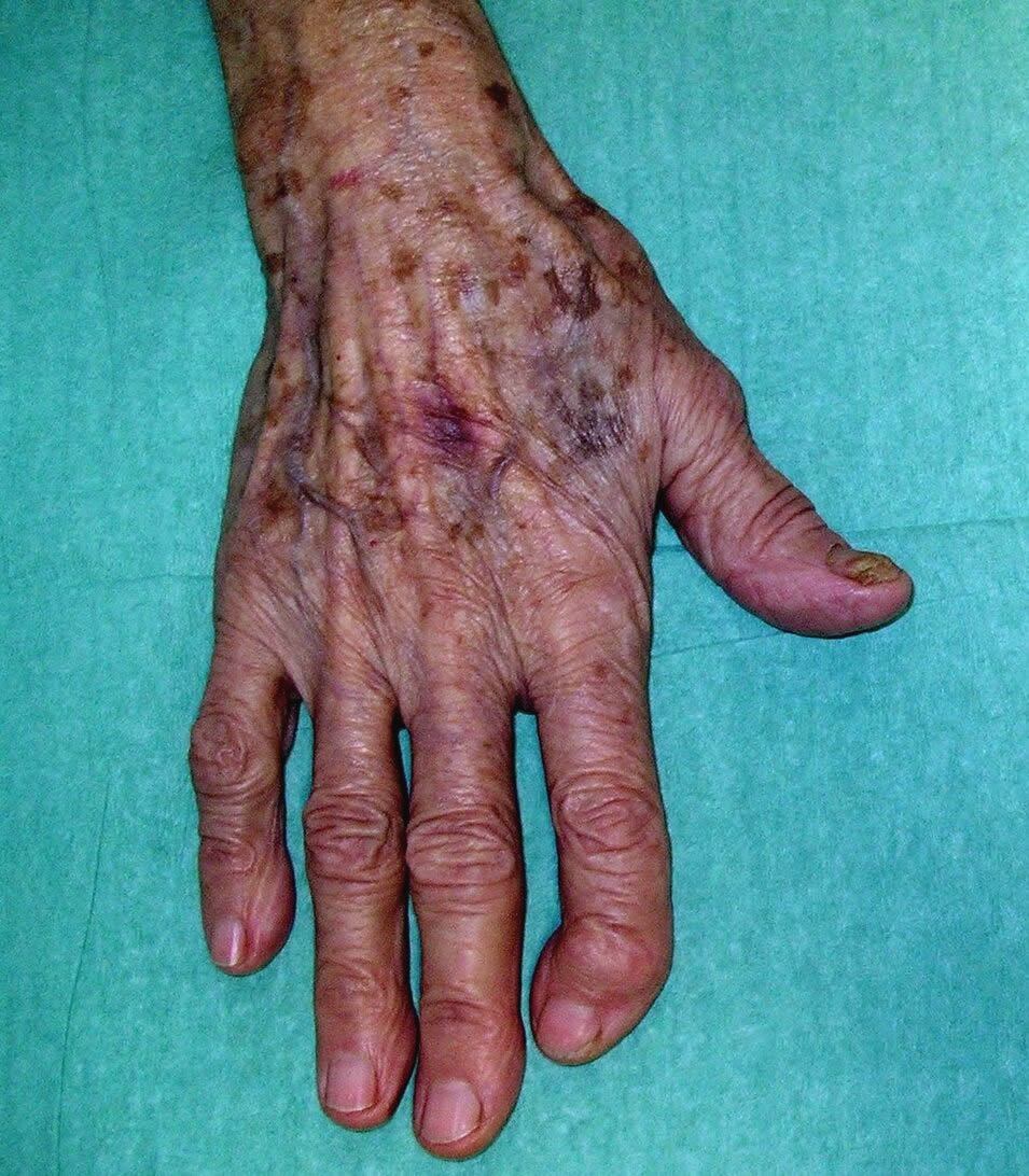 Wrist and hand osteoarthritis.