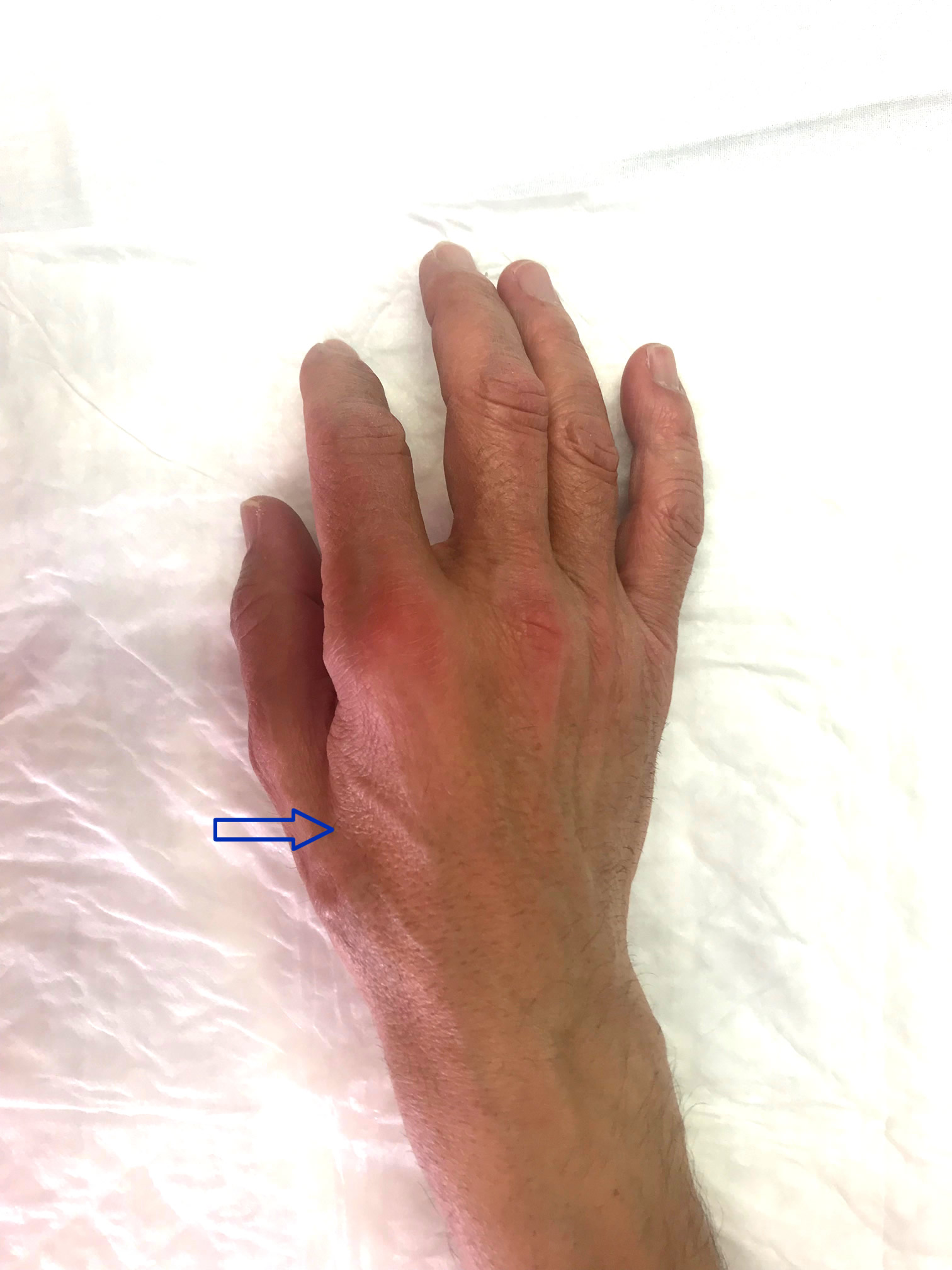 the little finger of the hand is numb: the compression of the ulnar nerve in the elbow