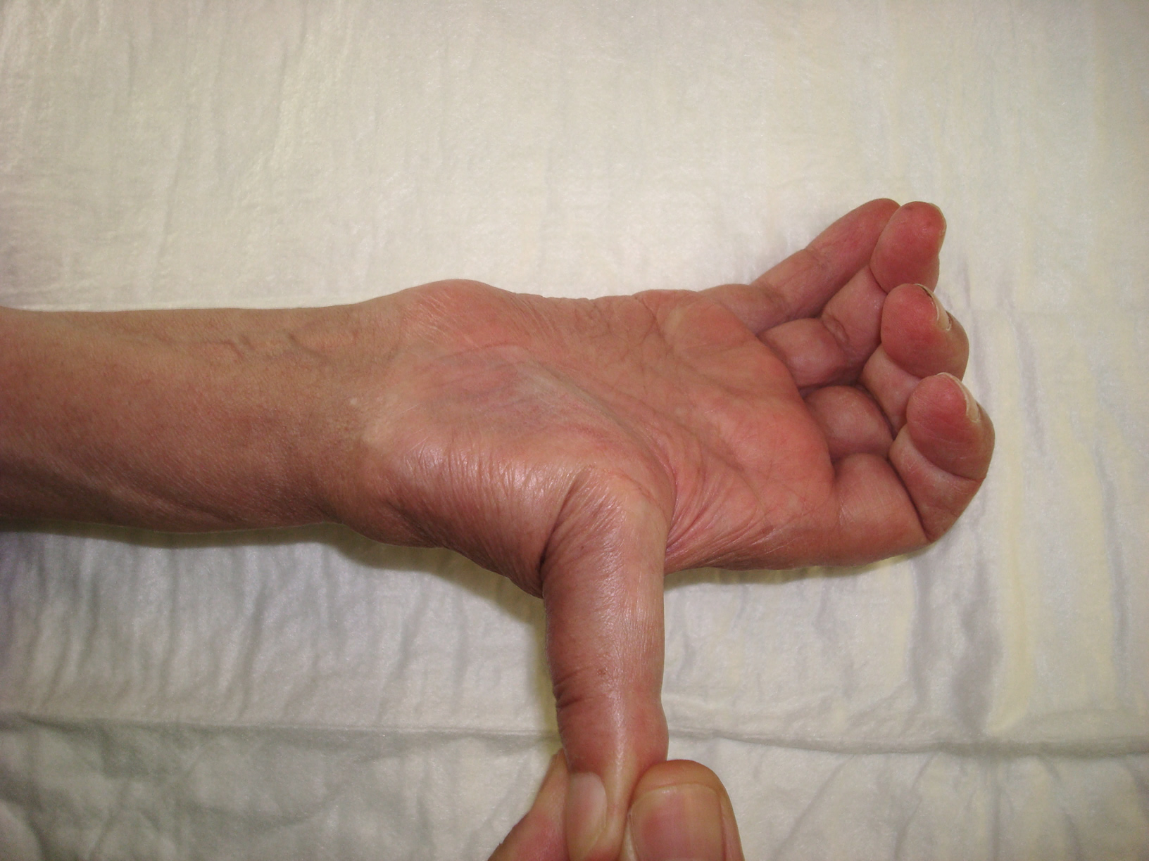 The ligamentous hyperlaxity can cause pain in the musician’s hand
