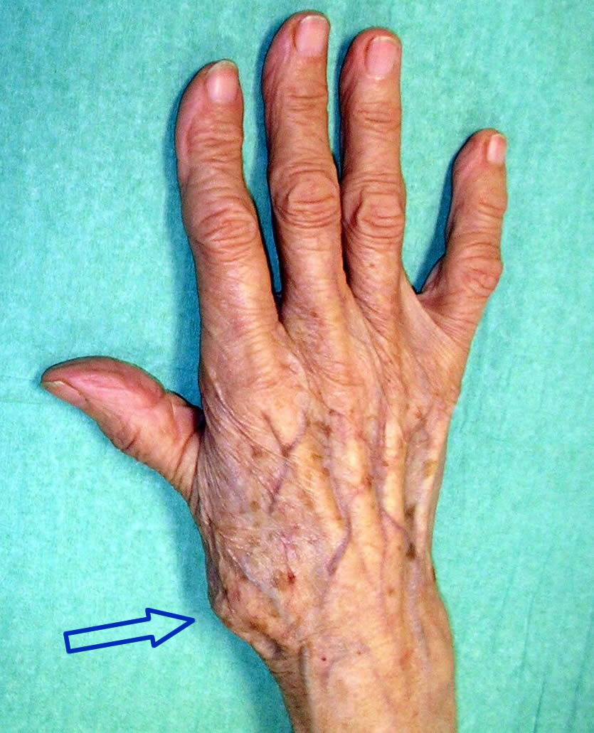 Thumb base osteoarthritis: first carpometacarpal osteoarthritis